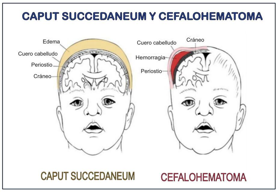 Difference Between Caput Succedaneum Vs Cephalohematoma