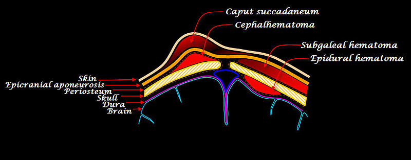 Common Cause Of Caput Succedaneum